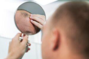 adult male having balding problems 23 2149152795 Hair Transplant Ads