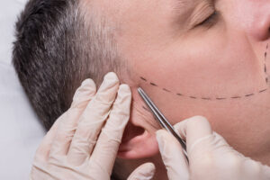 man beauty procedure beard hair implant senior man Sakal Bıyık Ekimi