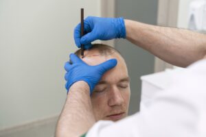mature man having balding problems DHI Hair Transplant